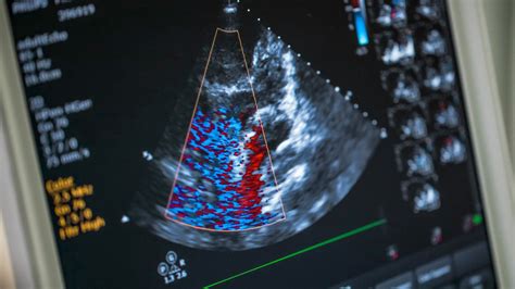 how long is echocardiogram valid|Types of Echocardiogram Tests and What to Expect.